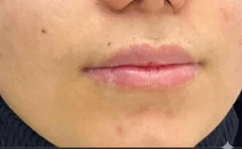 قبل حقن الفيلر التجميلي في مجمع أيار السابع الطبي جازان